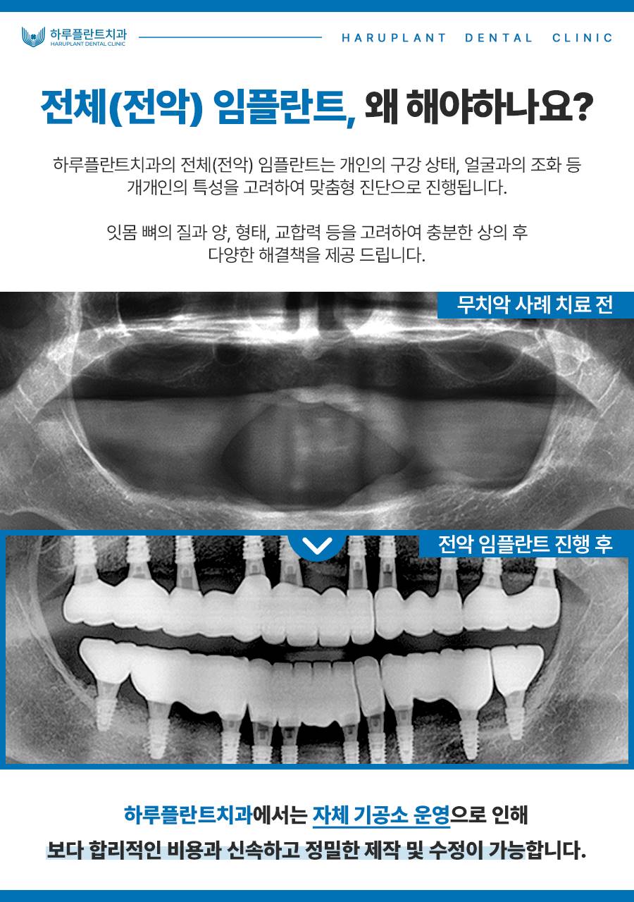 전악 임플란트 비용, 저희는 이 3가지로 비용을 줄였습니다. 관련 이미지 4