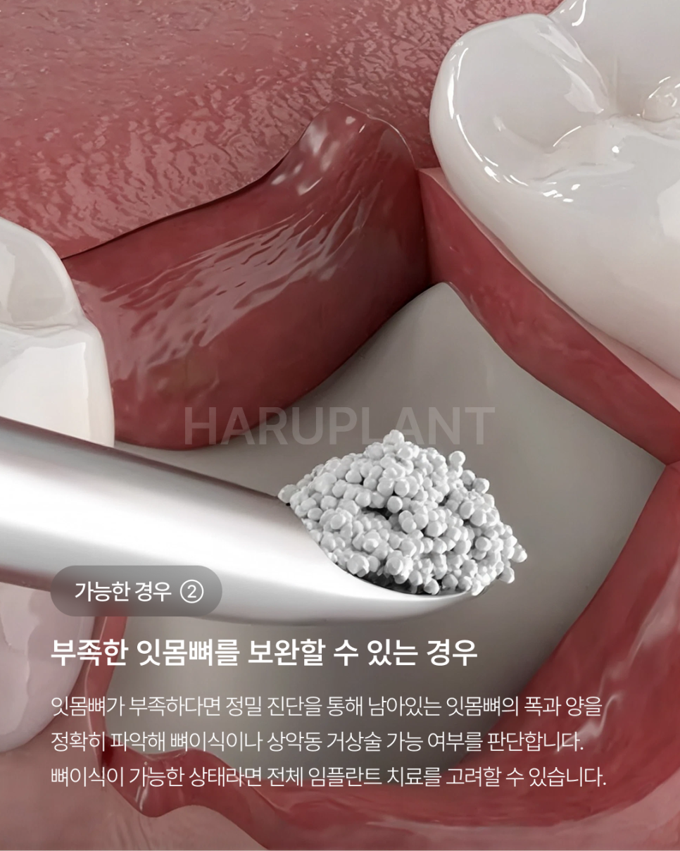 오랜 틀니 사용 후 전체 임플란트가 가능한 경우, 임플란트 종류와 전체 임플란트 뜻까지 관련 이미지 4