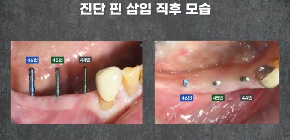 임플란트 전문가 변성만 원장 TV 출연 - 통증 줄인 무절개 임플란트 관련 이미지 6