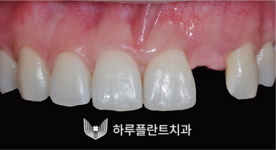 강남역 하루플란트치과 앞니 임플란트 후기 전후차이 관련 이미지 6