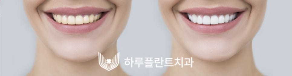 강남치과 하루플란트치과 치아미백 고민중이라면 관련 이미지 4
