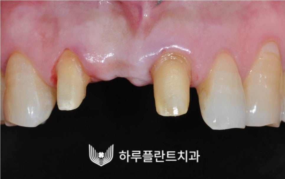 강남역 하루플란트치과 앞니 임플란트 후기 전후차이 관련 이미지 10