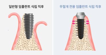 통증 줄이고 회복 빠른 하루플란트치과 CLS 무절개 임플란트 관련 이미지 8