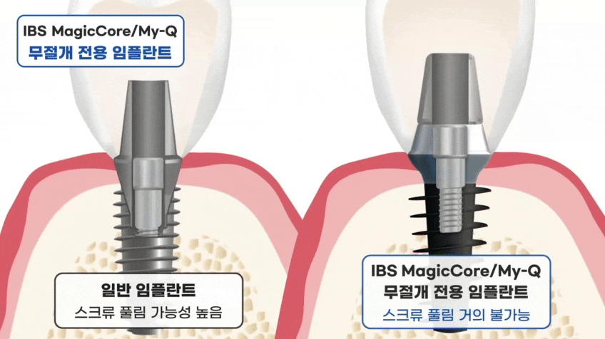 임플란트 평생 쓸 수 있나요? 오래 쓰는 방법 대공개(무절개 임플란트 수명) 관련 이미지 5