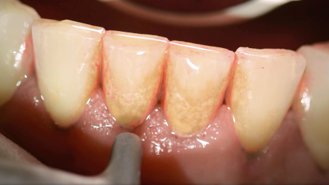 강남역스케일링 통증,시림 없는 프리미엄 에어플로우 스케일링 관련 이미지 11