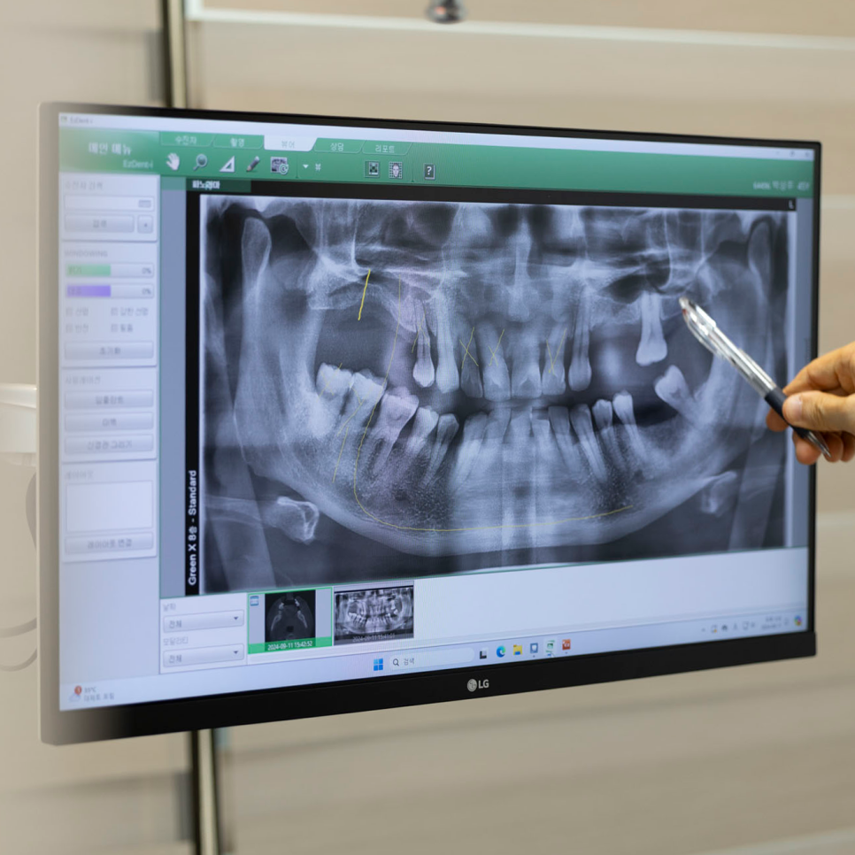 뼈이식 없이 임플란트 하면 안 되나요? 임플란트 뼈이식에 대해 하루플란트가 답해드립니다! 관련 이미지 4