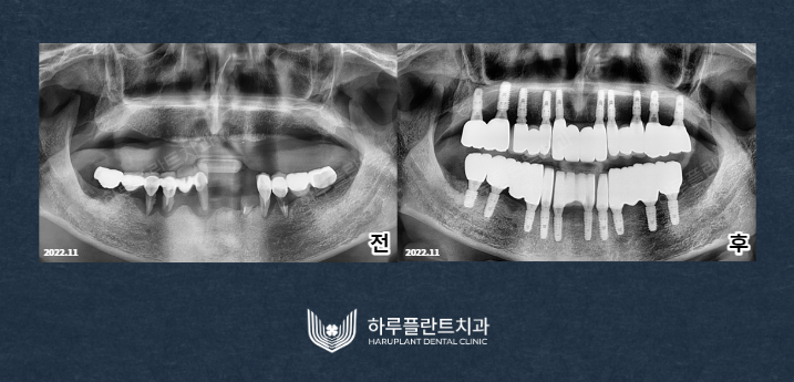강남역치과 무치악 임플란트 알아보고 있다면 관련 이미지 4