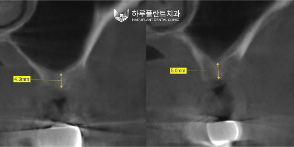 강남역 하루플란트치과 임플란트 무절개 상악동 거상술 진행 케이스 관련 이미지 7
