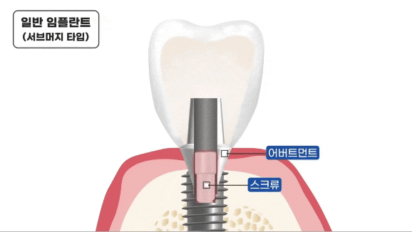 임플란트 평생 쓸 수 있나요? 오래 쓰는 방법 대공개(무절개 임플란트 수명) 관련 이미지 6