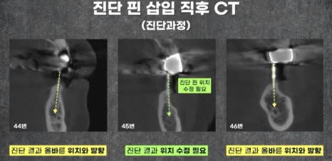 임플란트 전문가 변성만 원장 TV 출연 - 통증 줄인 무절개 임플란트 관련 이미지 8