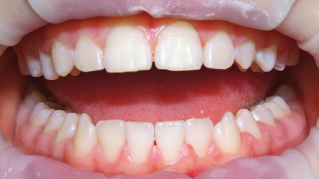 강남역스케일링 통증,시림 없는 프리미엄 에어플로우 스케일링 관련 이미지 8