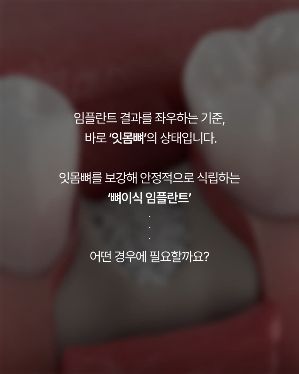 임플란트뼈이식, 반드시 필요할까요? 강남임플란트 하루플란트에서 기준을 확인하세요 관련 이미지 2