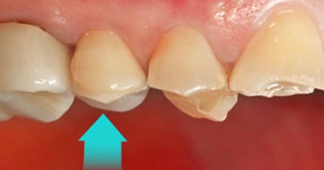 치과당일치료 하루플란트치과의 혁신적인 하루완성 클리닉 관련 이미지 10