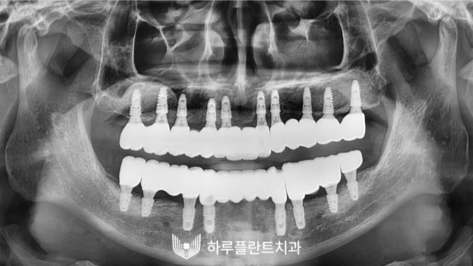 하루플란트치과 변성만 대표원장 타치과 임플란트 불가판정 성공사례 관련 이미지 4