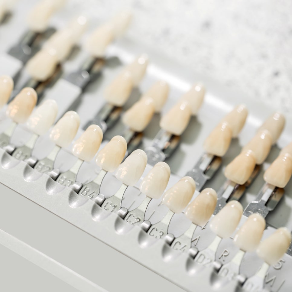 변색 치아, 단 하루면 충분하다? 하루플란트의 치아 미백 과정 전격 대공개! 관련 이미지 4