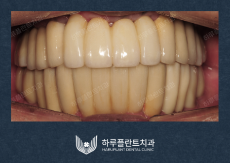 강남역치과 무치악 임플란트 알아보고 있다면 관련 이미지 7