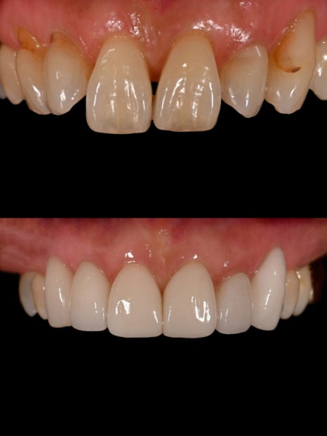 치아 사이 틈, 하루네이트로 해결할 수 있습니다 관련 이미지 7