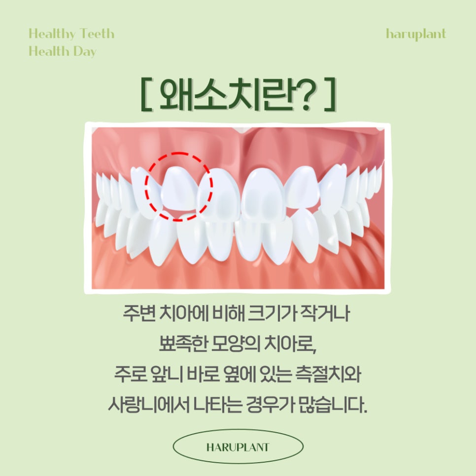 강남역 하루플란트치과 작은이빨 왜소치 치료방법은? 관련 이미지 2