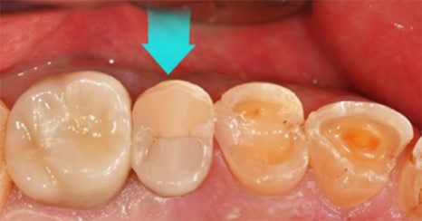 치과당일치료 하루플란트치과의 혁신적인 하루완성 클리닉 관련 이미지 11