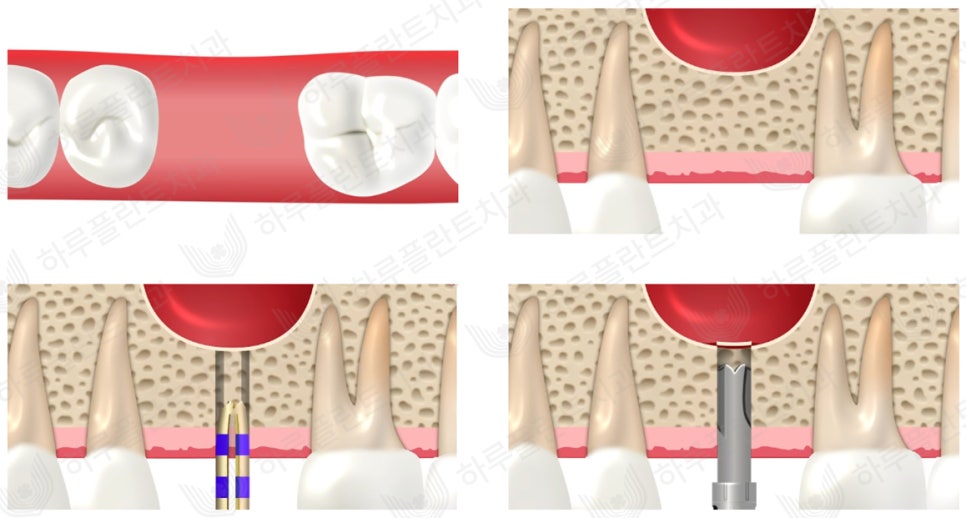 강남역 하루플란트치과 임플란트 무절개 상악동 거상술 진행 케이스 관련 이미지 3