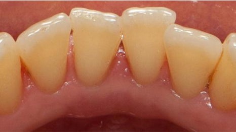 강남역스케일링 통증,시림 없는 프리미엄 에어플로우 스케일링 관련 이미지 10