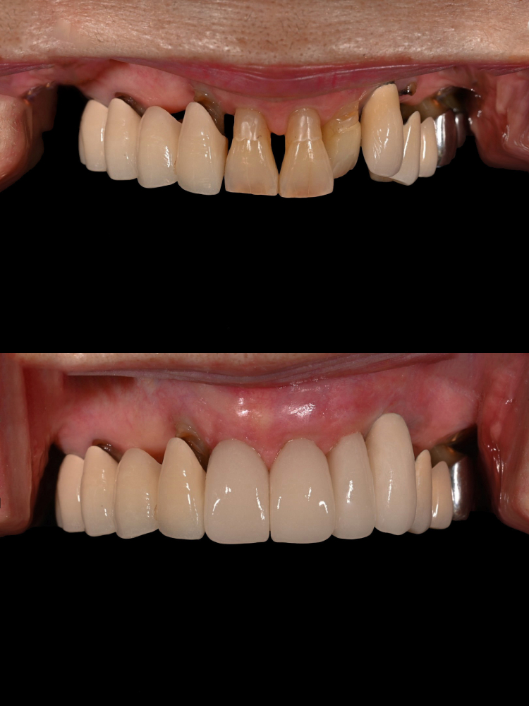 치아 사이 틈, 하루네이트로 해결할 수 있습니다 관련 이미지 5