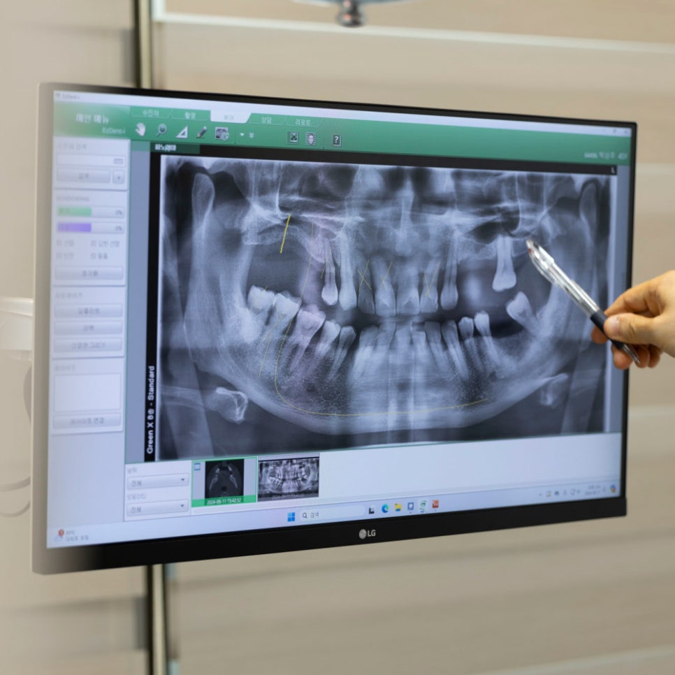 임플란트 회복기간, 빨라지는 비결? 하루플란트 플라즈마 임플란트가 도와드립니다! 관련 이미지 2