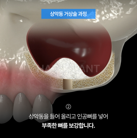 상악동거상술 뜻과 종류로 알아보는 위턱 어금니가 고난도임플란트가 되는 이유 관련 이미지 5
