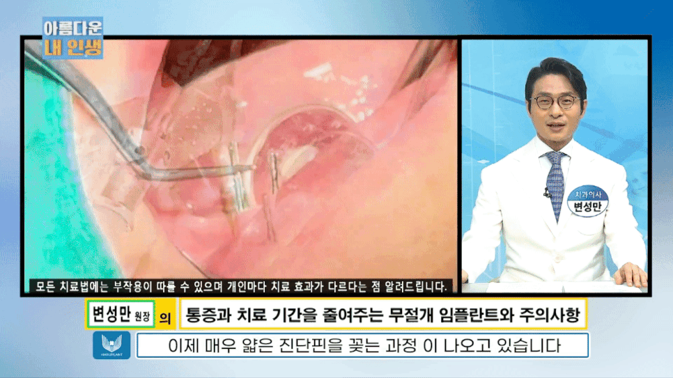 임플란트 전문가 변성만 원장 TV 출연 - 통증 줄인 무절개 임플란트 관련 이미지 5