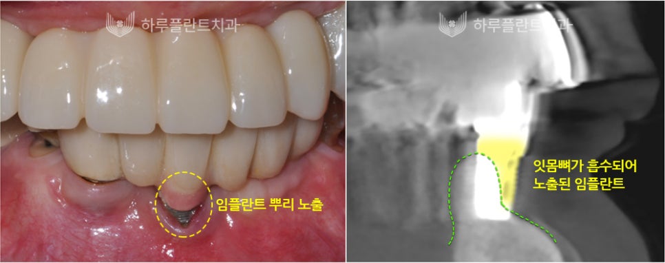 강남역치과 하루플란트치과 임플란트 주위염 원인부터 예방법까지 관련 이미지 4