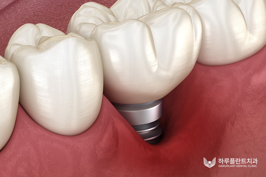 임플란트 뼈이식 후 음주? 이 글을 확인하세요 관련 이미지 4