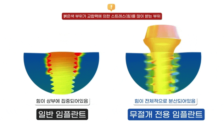 임플란트 평생 쓸 수 있나요? 오래 쓰는 방법 대공개(무절개 임플란트 수명) 관련 이미지 8