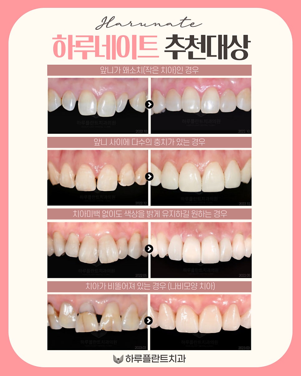 강남역 하루플란트치과 당일 완성 라미네이트 <하루네이트> 관련 이미지 7