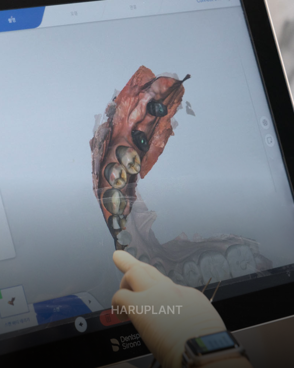 Why All-on-X Implants May Be Worth Considering Even If You Have Been Told That Full-Arch Implants Are Difficult image 12