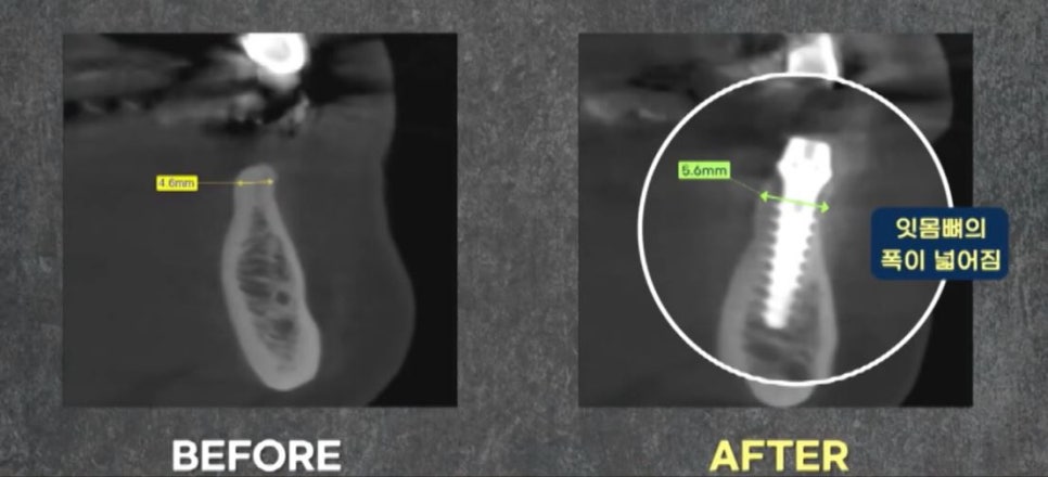 임플란트 전문가 변성만 원장 TV 출연 - 통증 줄인 무절개 임플란트 관련 이미지 14