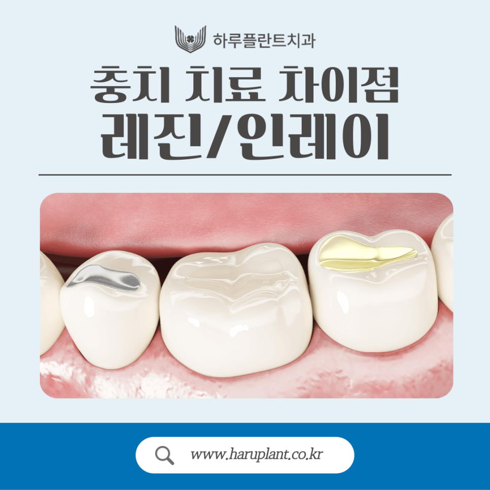 강남충치치료 레진 인레이 차이는? 관련 이미지 1