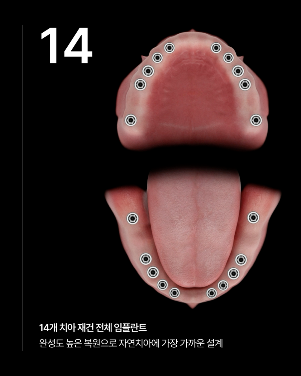How Many Implants Are Needed for Full-Mouth Implant Treatment? The Type and Cost of Full-Arch Implants Vary Depending on the Number That Suits You image 4