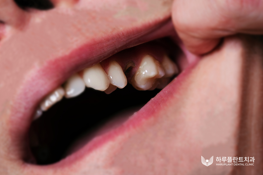 강남 원데이 임플란트, 하루만에 가능한 방법 알려드립니다 관련 이미지 2