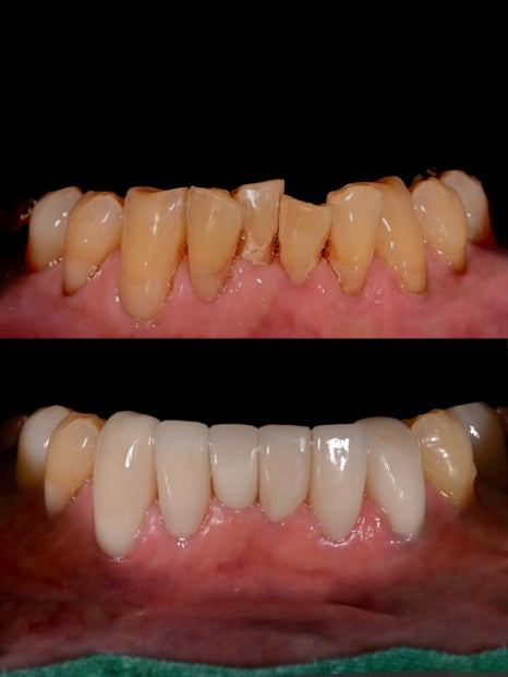 치아 사이 틈, 하루네이트로 해결할 수 있습니다 관련 이미지 10