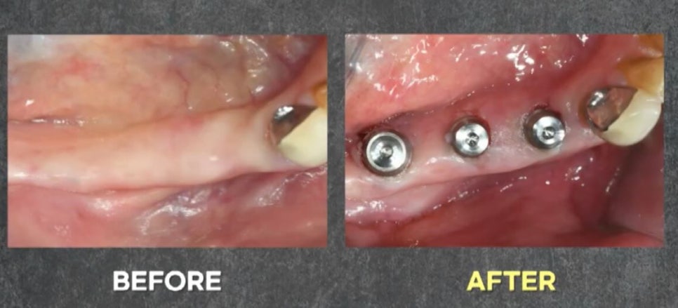 임플란트 전문가 변성만 원장 TV 출연 - 통증 줄인 무절개 임플란트 관련 이미지 15