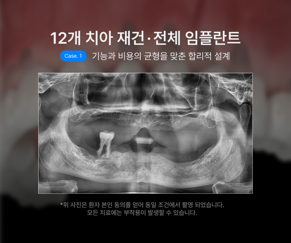 How Many Implants Are Needed for Full-Mouth Implant Treatment? The Type and Cost of Full-Arch Implants Vary Depending on the Number That Suits You image 5
