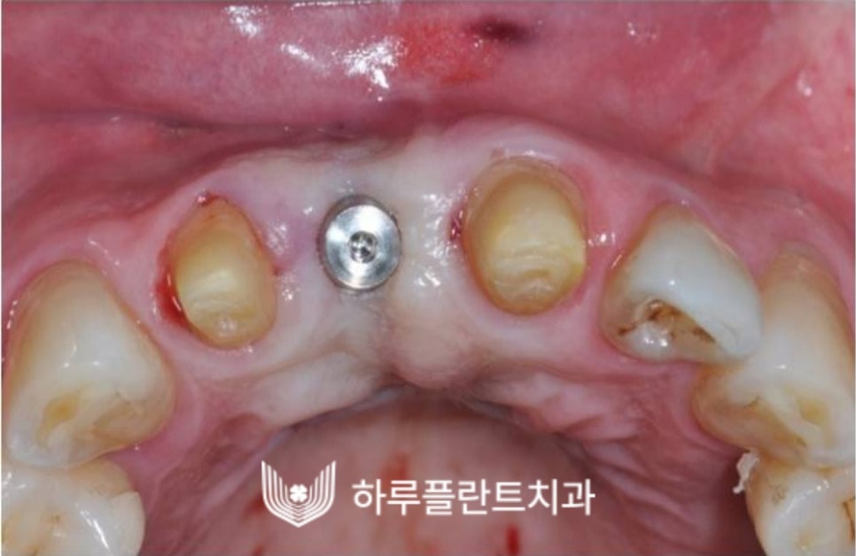 강남역 하루플란트치과 앞니 임플란트 후기 전후차이 관련 이미지 12