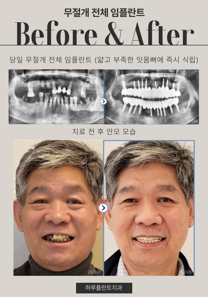 강남구전체임플란트 잘하는곳 이것만은 꼭 확인하세요 관련 이미지 6