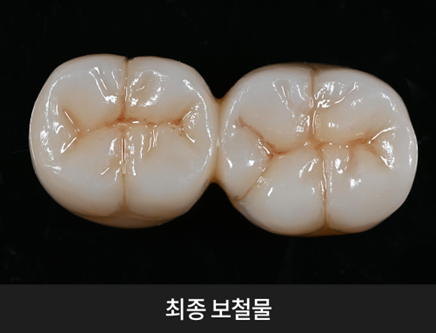 치과당일치료 하루플란트치과의 혁신적인 하루완성 클리닉 관련 이미지 4