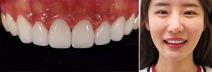 치과당일치료 하루플란트치과의 혁신적인 하루완성 클리닉 관련 이미지 7