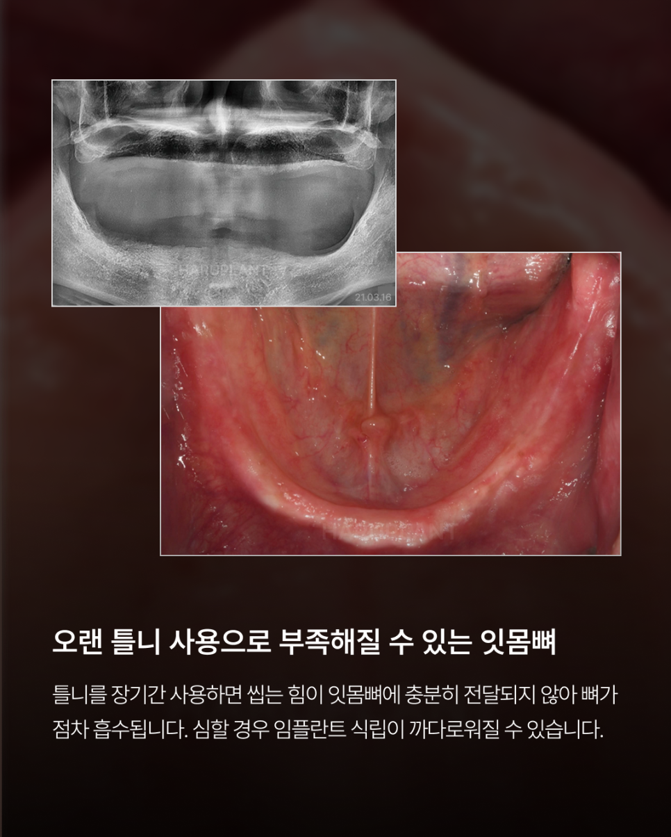 오랜 틀니 사용 후 전체 임플란트가 가능한 경우, 임플란트 종류와 전체 임플란트 뜻까지 관련 이미지 2