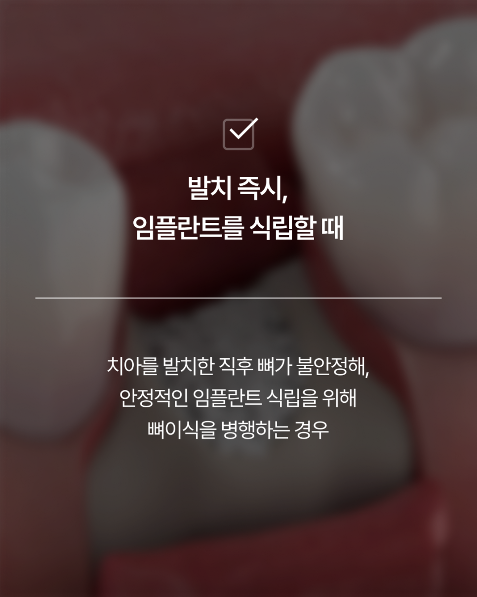 임플란트뼈이식, 반드시 필요할까요? 강남임플란트 하루플란트에서 기준을 확인하세요 관련 이미지 3