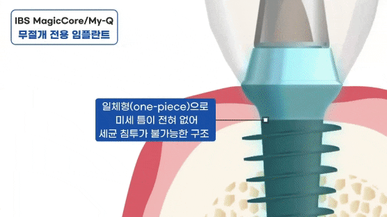 임플란트 평생 쓸 수 있나요? 오래 쓰는 방법 대공개(무절개 임플란트 수명) 관련 이미지 4