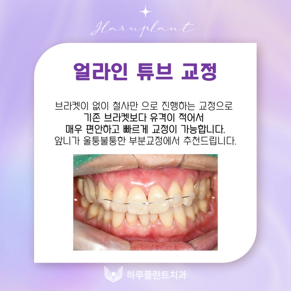 강남역치과 하루플란트치과 치아교정 개인별 맞춤 교정으로 관련 이미지 18