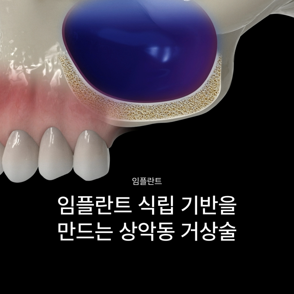 상악동거상술 뜻과 종류로 알아보는 위턱 어금니가 고난도임플란트가 되는 이유 관련 이미지 1